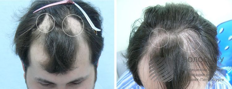 Пересадка волос нижний новгород